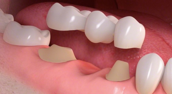Fixed Partial Denture in abu dhabi