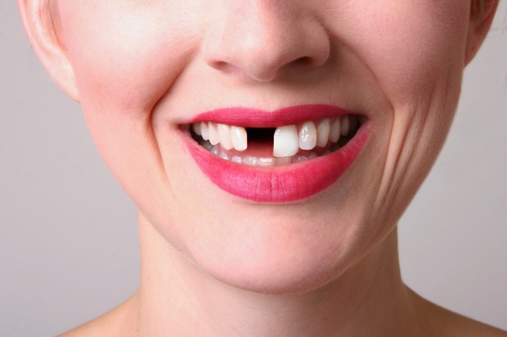losing teeth, dental implant