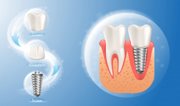 dental implant in abu dhabi khalifa street