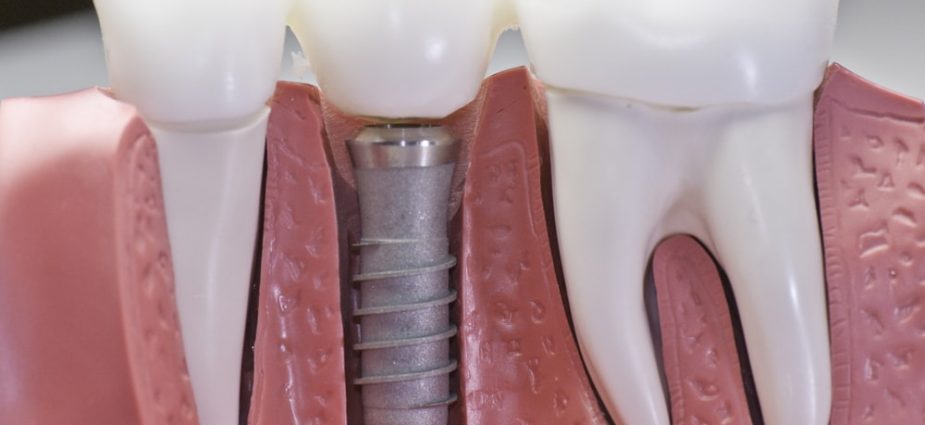 dental implants in abu dhabi 3d