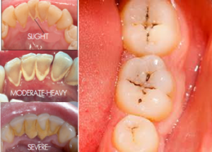 prevent plaque and tooth decay