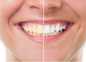 white teeth before and after