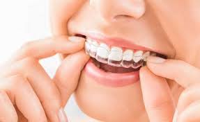 abu dhabi invisalign center abu dhabi invisalign center