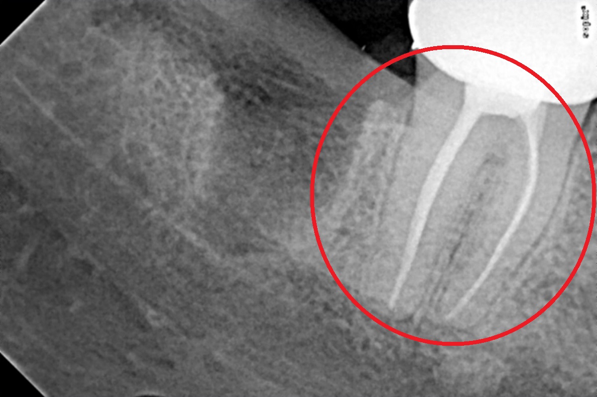 wisdom tooth removal abu dhabi