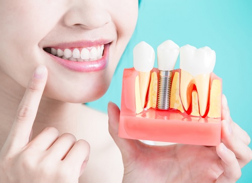 all about dental implant in abu dhabi